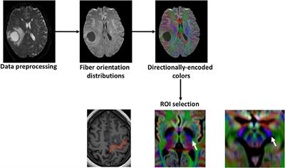 Constrained-Spherical Deconvolution Tractography in the Evaluation of the Corticospinal Tract in Glioma Surgery